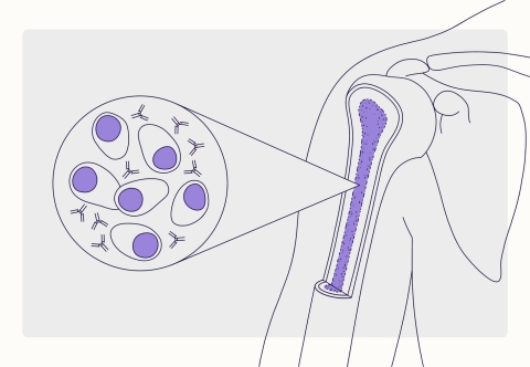 Điều trị đa u tủy sống (multiple myeloma)